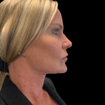 after-deep-plane-facelift-necklift